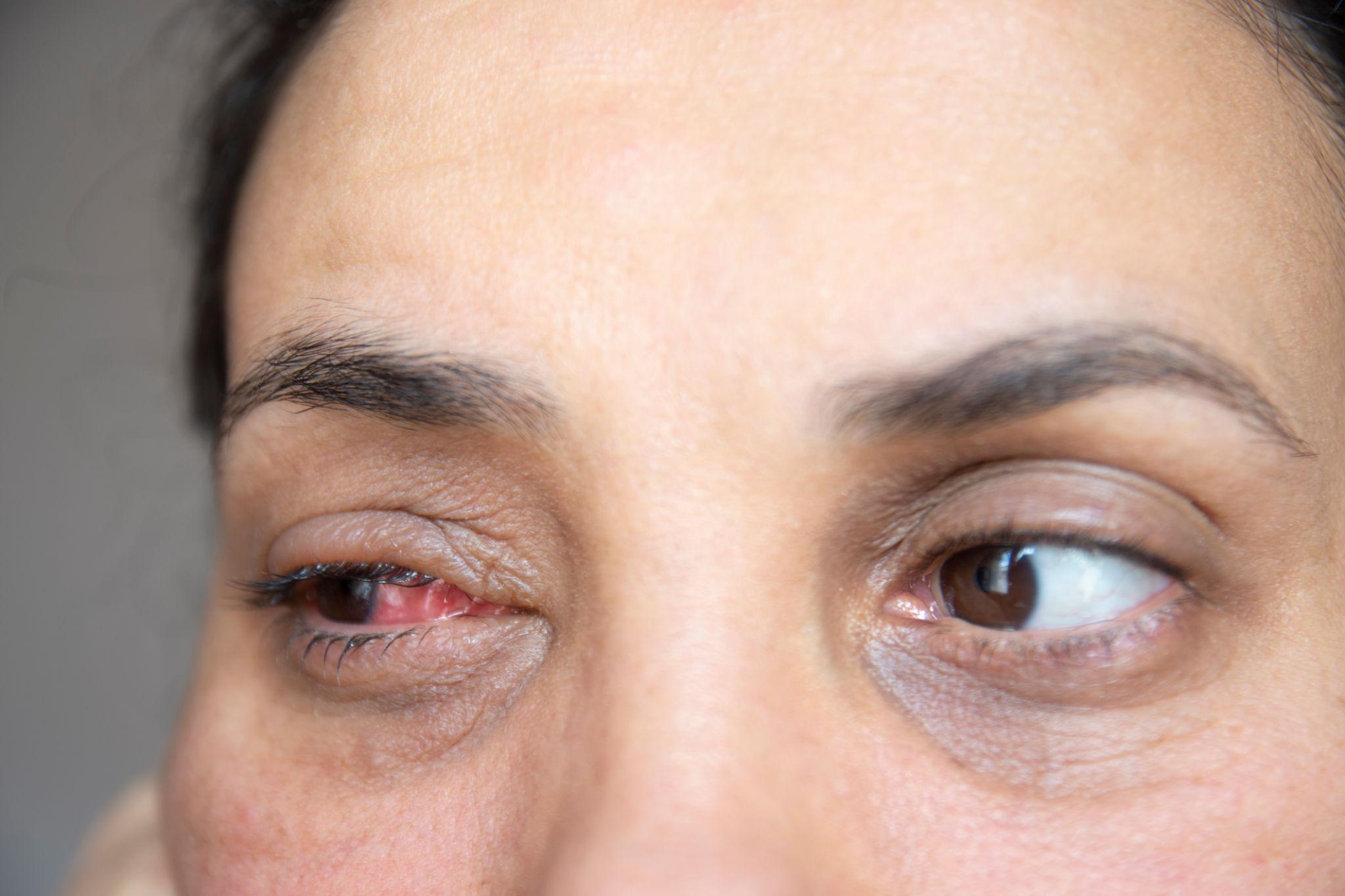 “Woman recovering from cosmetic eye surgery while covering one eye”
